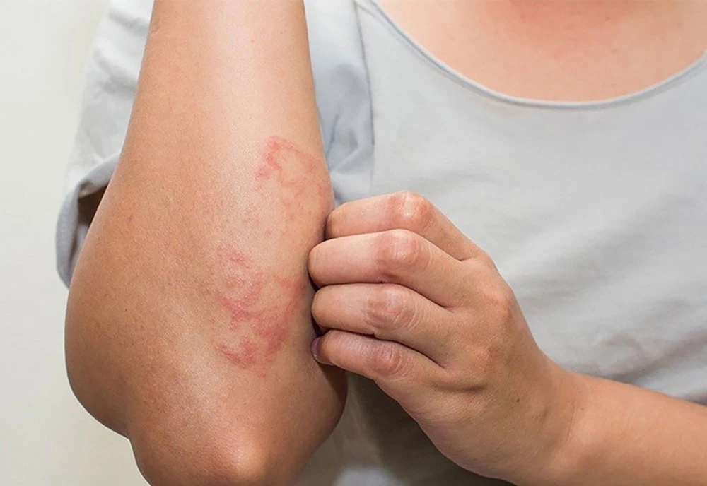 Nếu có cơ địa dễ dị ứng, bạn cũng nên cân nhắc khi sử dụng đông trùng hạ thảo Nếu có cơ địa dễ dị ứng, bạn cũng nên cân nhắc khi sử dụng đông trùng hạ thảo