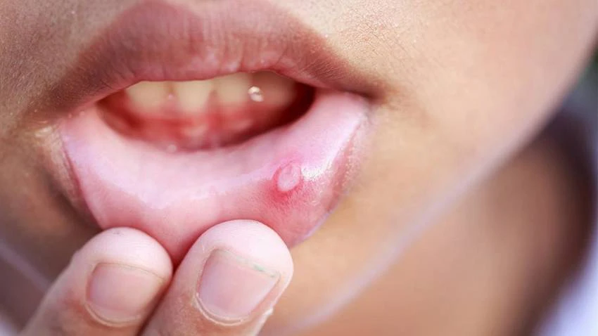 Trong mật ong có chứa nhiều hoạt chất hỗ trợ kháng khuẩn, kháng viêm trong quá trình điều trị nhiệt miệng Trong mật ong có chứa nhiều hoạt chất hỗ trợ kháng khuẩn, kháng viêm trong quá trình điều trị nhiệt miệng
