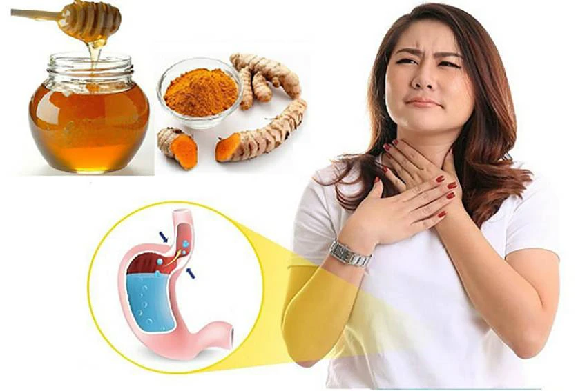 Mật ong Manuka kết hợp tinh bột nghệ là cách giúp giảm đau, trào ngược dạ dày hiệu quả Mật ong Manuka kết hợp tinh bột nghệ là cách giúp giảm đau, trào ngược dạ dày hiệu quả