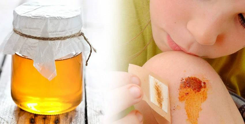 Mật ong giúp phòng nhiễm trùng và làm lành vết thương nhanh chóng